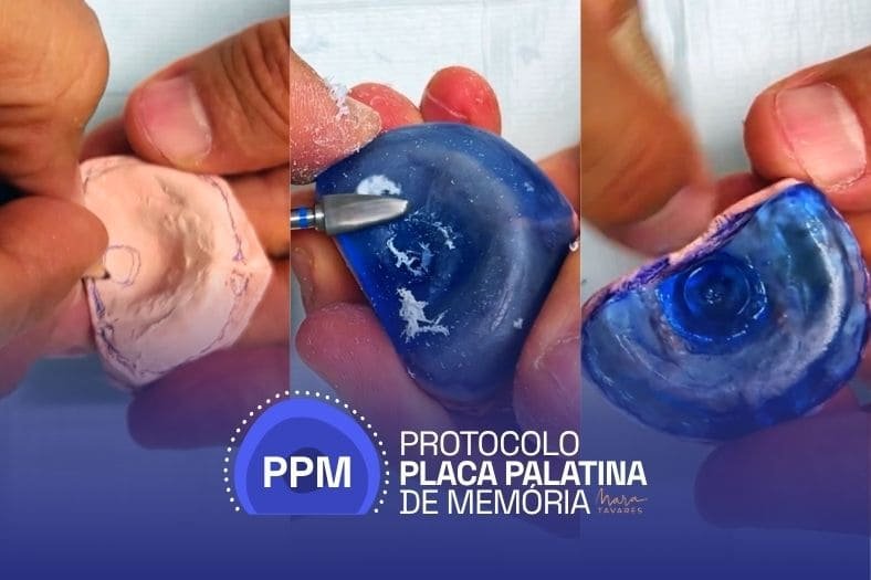 Confecção laboratorial da Placa Palatina de Memória